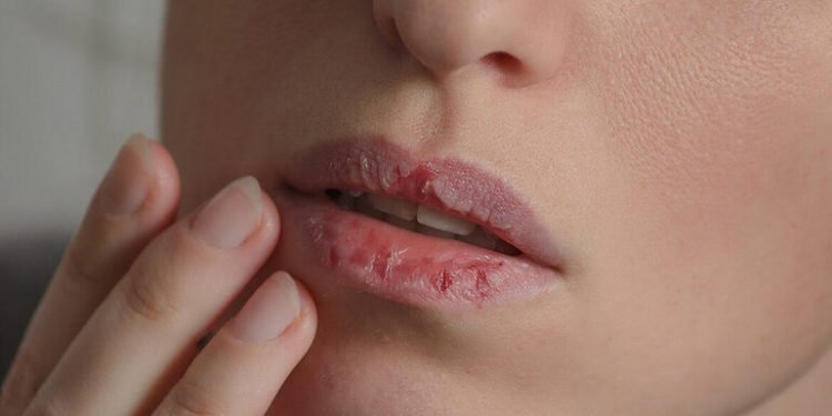 COVID Tongue: ओठांभोवती पाच लक्षणं जाणवल्यास कोरोना चाचणी नक्की करा