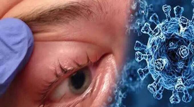 mucor-mycosis